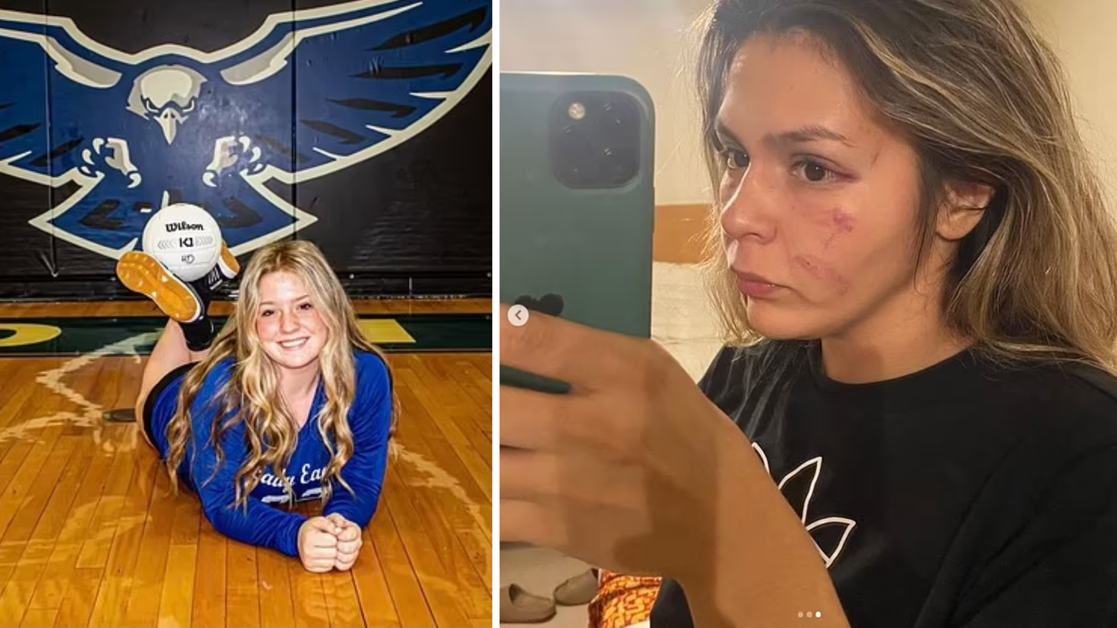 Volleyball Player Paralyzed with Brain Damage